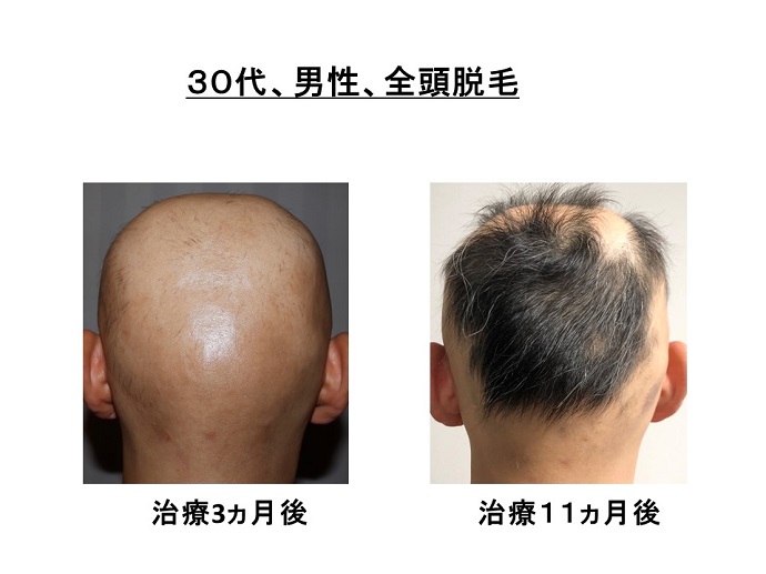 円形脱毛症　病院